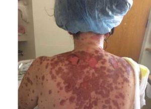 Picture of a woman's pair back showing the skin covered with nickel -sized brown spots that run together in many places. In other spots, the skin is raw and oozing